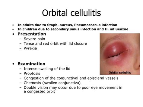 Explore the Hope of Healing: Treatment Options for Orbital Cellulitis at Your Local Optometrist